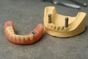 Snap-in denture next to a jaw model with implants